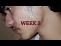 Download Lagu Minoxidil 5 month journey from zero to hero!