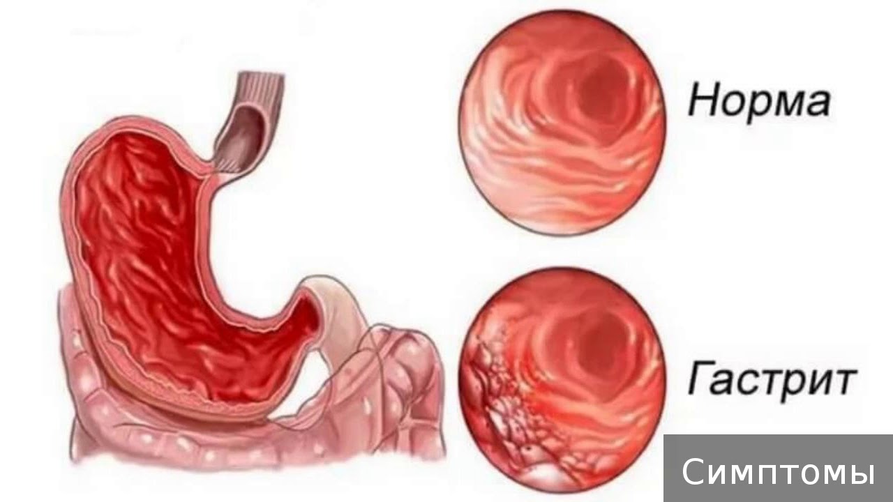 Слизистой оболочки желудка признаки. Норма и хронический гастрит. Гастролит. Острый и хронический гастрит.