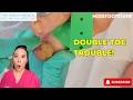 Double Trouble: Fungal Nail &amp; Ingrown Toenail Treated in One Session by  Miss Foot Fixer Marion Yau