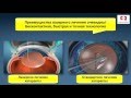 Катаракта операция лазером, лазерная факоэмульсификация, удаление катаракты бесконтактным способом
