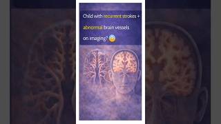 Child with Recurrent Strokes? ⚠️ #medicalshorts #marginofvitals #mbbs #medical #medicalstudent