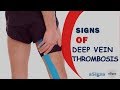 10 Signs of Deep Vein Thrombosis