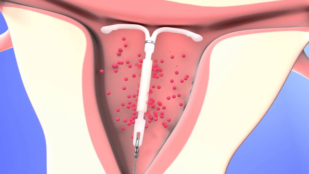 Nach entfernung hormonumstellung mirena Wie lange