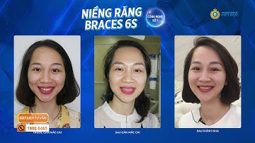 NIỀNG RĂNG MẮC CÀI SỨ THẨM MỸ VÀ NIỀM VUI NGÀY THÁO NIỀNG CỦA CÔ GÁI