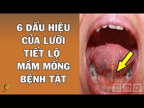 Lưỡi Màu Đen - Vạch Lưỡi Ra Nhìn Thấy 6 Dấu Hiệu Này Thì Phải Đi Kiểm Tra Ngay Kẻo Bệnh Tật Đầy Người