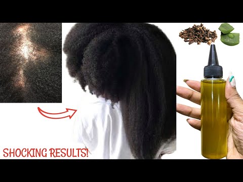 SHOCKING RESULTS! Grow Hair Fast At Rocket Speed And Treat Baldness From The First Week