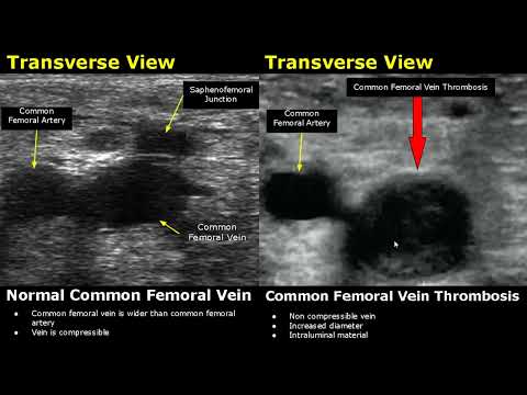 Image of Femoral Vein Doppler Ultrasound Normal Vs Abnormal Image Appearances 