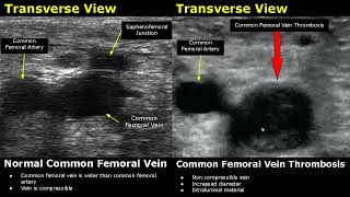 Femoral Vein Doppler Ultrasound Normal Vs Abnormal Image Appearances | Deep Vein Thrombosis USG Scan screenshot 4