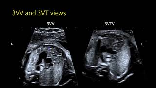 Fetal Echocardiography: The 3VTV and identifying arch abnormalities