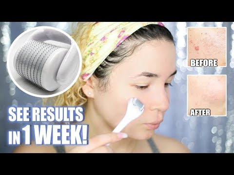 MICRONEEDLING to REMOVE ACNE SCARS!
