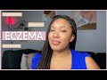 How to treat & heal ECZEMA | Tips, treatments, products & remedies to help get rid of eczema