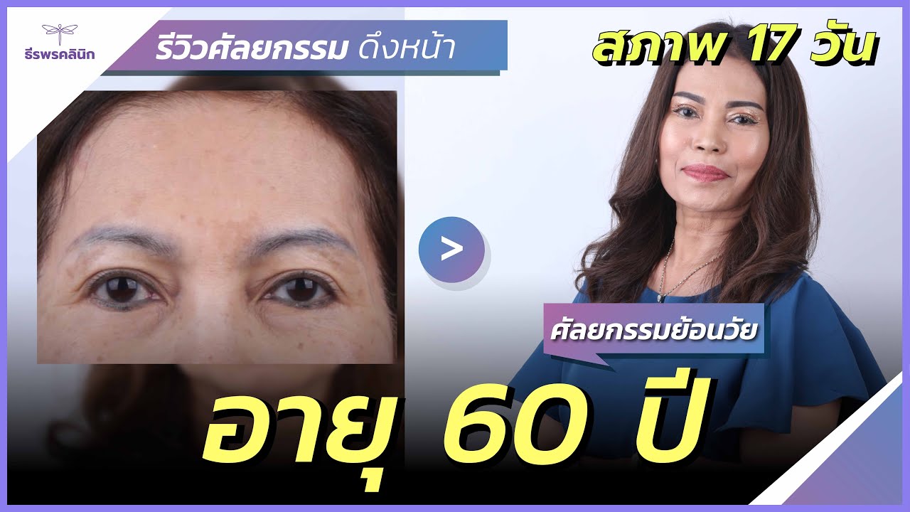 แค่หลับแล้วตื่น โอโห้เปลี่ยนเป็นอีกคน อายุ 60 ปี ดึงหน้า และตาสองชั้นไปแล้ว17วันธีรพรคลินิก หมอชลธิศ