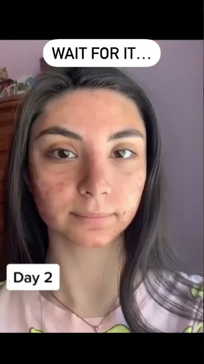 SKIN AFTER MICRONEEDLING #shorts