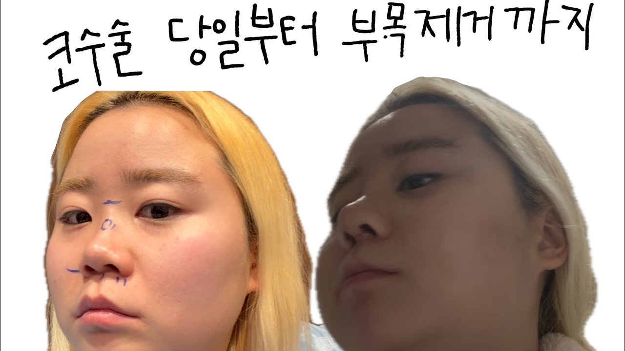코수술 후기 브이로그 가짜코의 삶 #코수술후기 #코수술전후 #코수술 