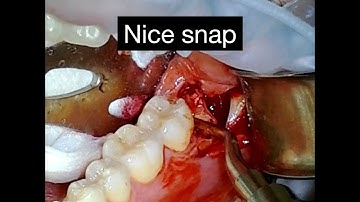 Distoangular Third Molar Removal Video