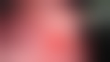 Bladder tumor removal by TURBT, by Urologist Dr Raj kumar sharma, Ranchi