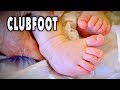 RARE CLUBFOOT (both feet) | Dr. Paul