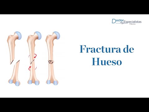 Especialista en crujir huesos