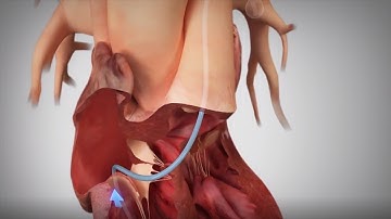 CardioMEMS HF System Animated Implant Procedure Overview