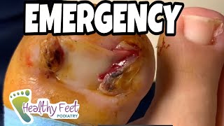 EXTREMELY INFECTED INGROWN TOENAILS WITH TOE MEAT DANGLING OVER THE SIDES OF BOTH BIG TOES!