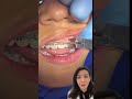 How Braces Are Removed?!