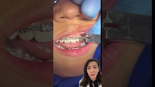 How Braces Are Removed?!...