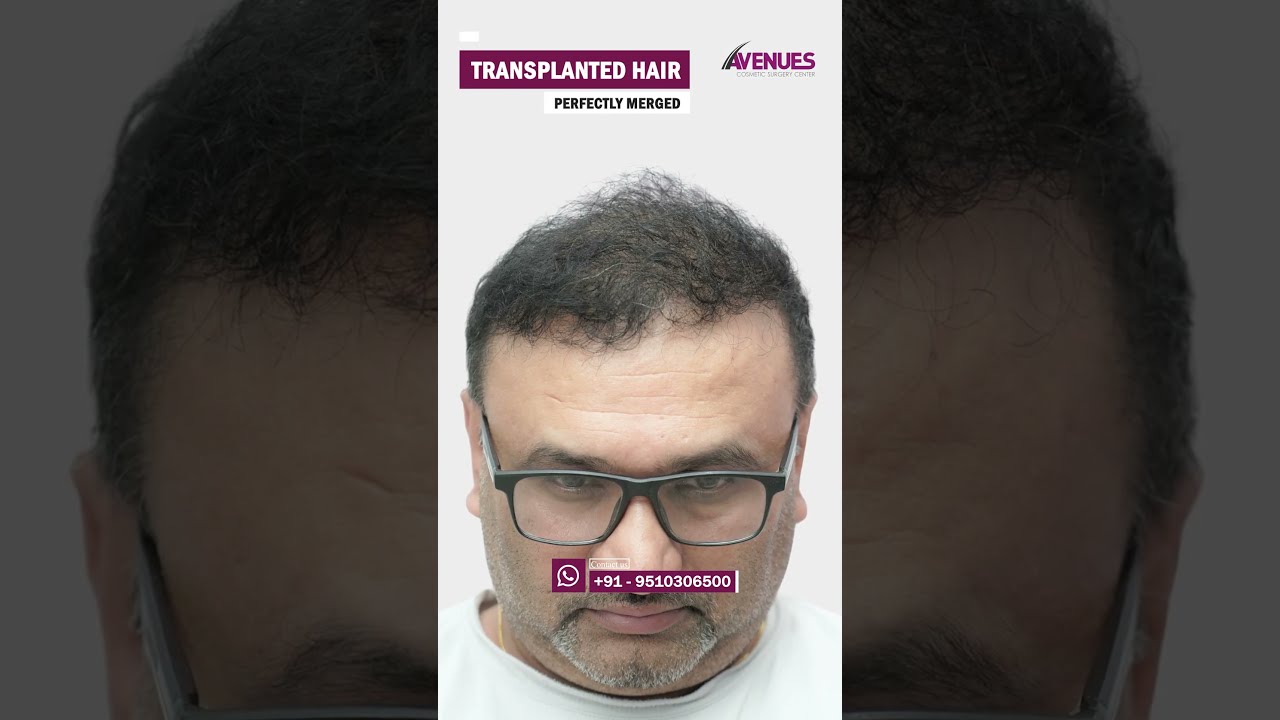 Hair Transplant Results In Ahmedabad Shorts Viral Fuehairtransplant