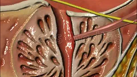 Dihydrotestosterone in BPH - Animated Atlas of BPH and OAB