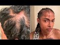 Scalp Irritation from Afreezm Braiding Hair