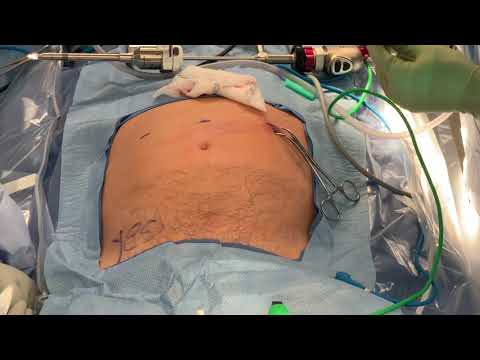 Port Placement for Robotic Inguinal Hernia Repair