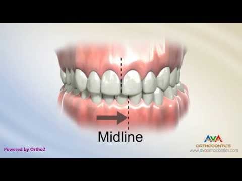 Orthodontic Treatment for Narrow Upper Jaw with Functional Shift - Expander or Spacer
