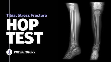 Hop Test | Tibial Stress Fractures