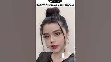 BOTOX HÀM + FILLER CẰM