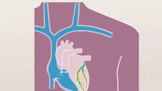 An animation explaining the implantation of a pacemaker