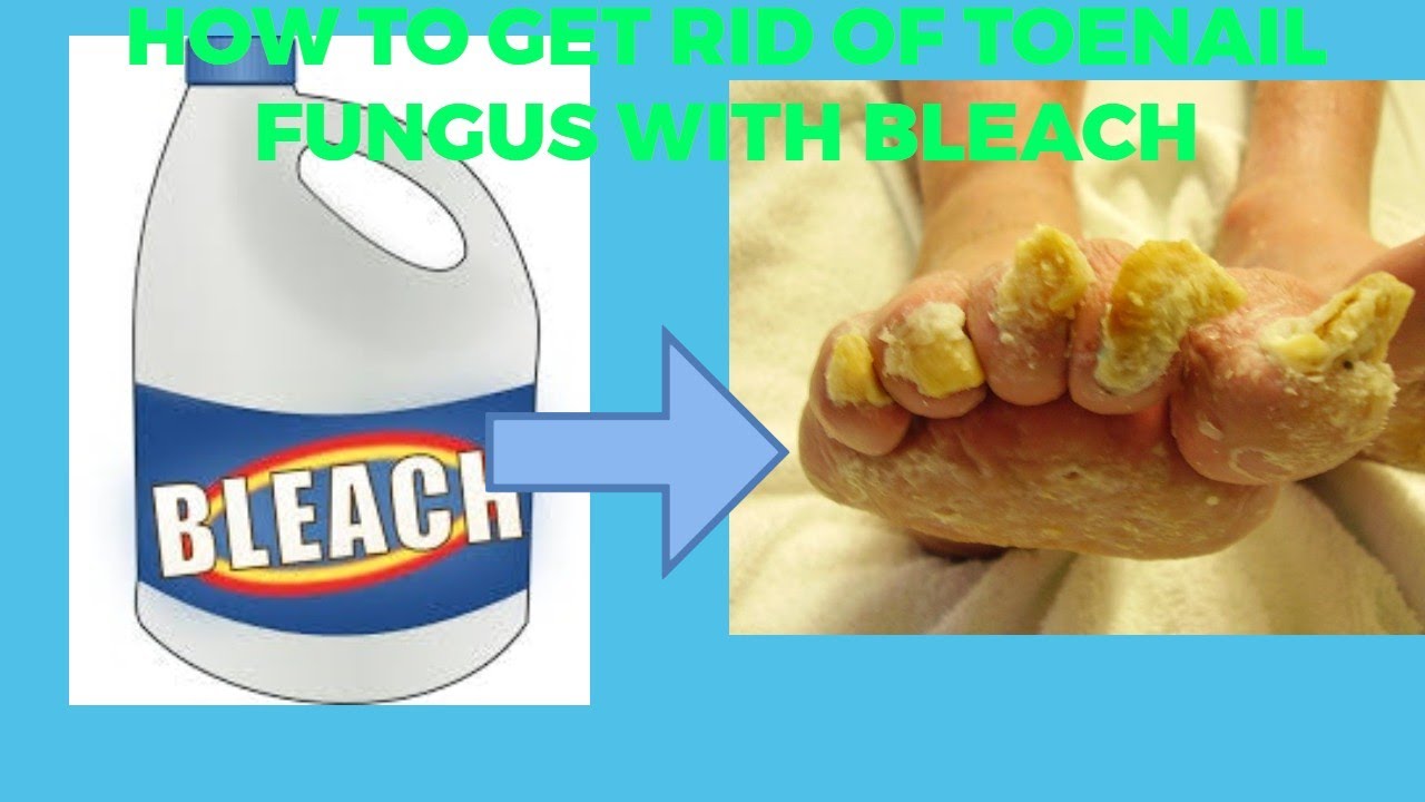 How To Get Rid Of Toenail Fungus With Bleach Youtube