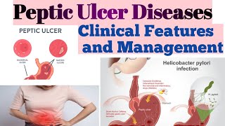 What is PUD .PUD Kya HOTA hai.Peptic Ulcers Diseases causes,clinical features and its management.