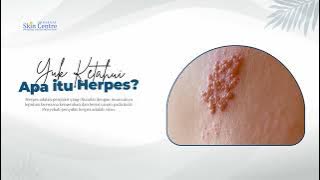 Tips Menangani Penyakit Herpes