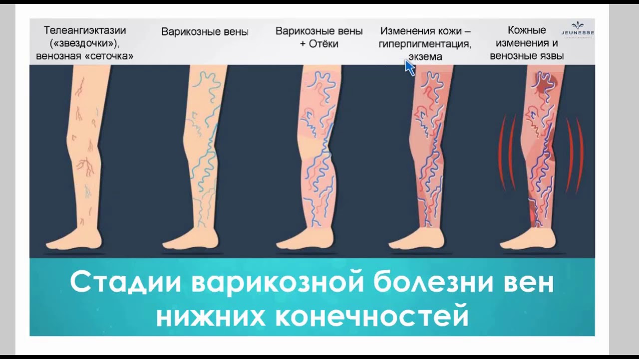 Варикозное Расширение Вен На Ногах Симптомы И Лечение