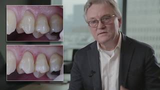 Kulzer - Perfect class V restorations - flow or conventional composite