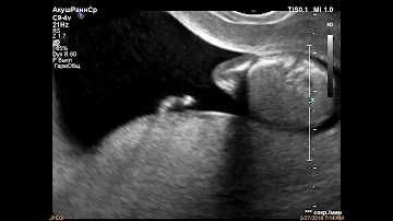 Экзэнцефалия/exencephaly