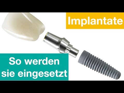 Video: Wie viel kosten enossale Implantate?