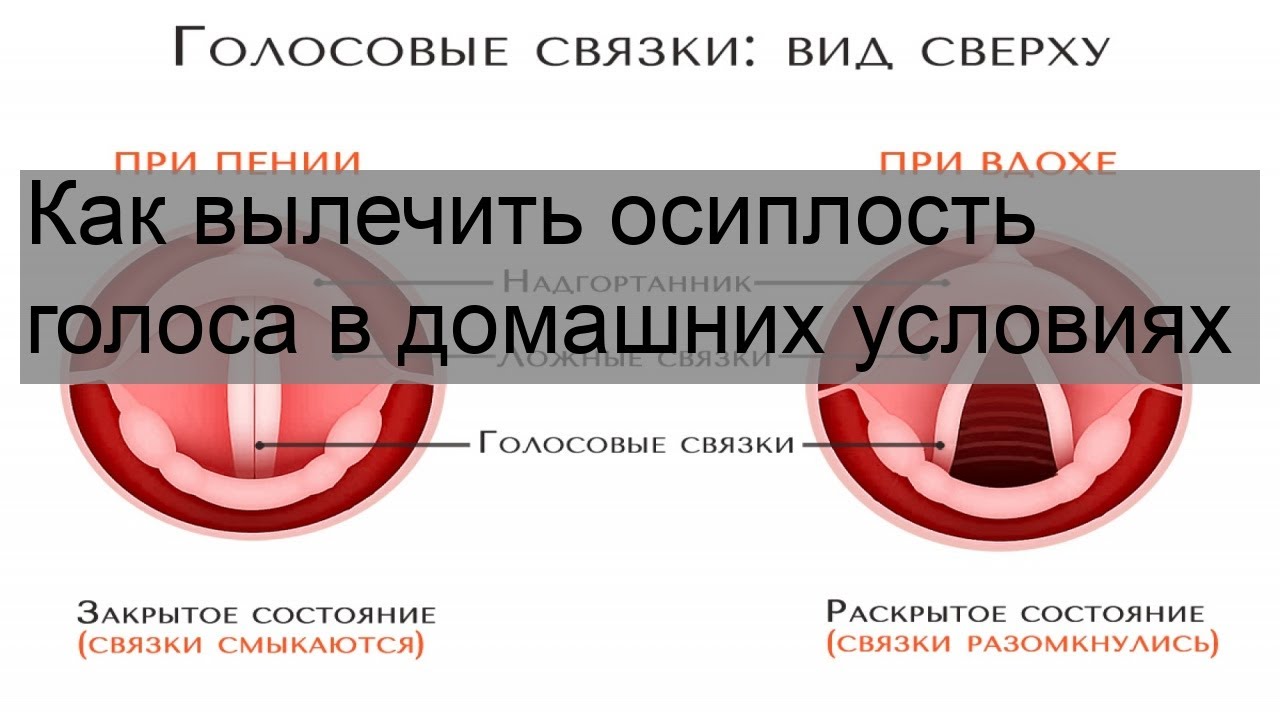 Лечение голосовых. Осиплость голоса. Лечение голосовых связок при осиплости голоса лекарства. Лечение голосовых связок в домашних условиях. Осиплость голоса народные методы лечения.