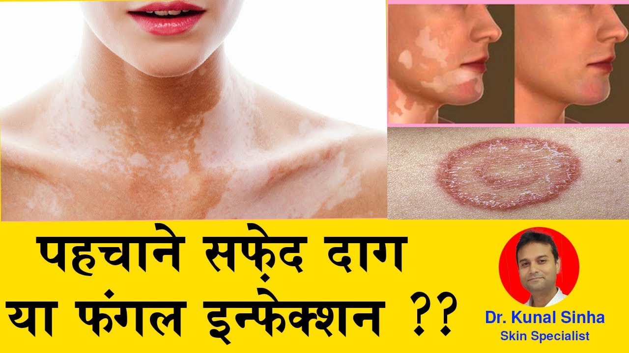 Info about Vitiligo and leucoderma in Hindi YouTube