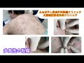 背部の多発性の粉瘤 ブログでも粉瘤について詳しく解説してます 東京皮膚のできものと粉瘤クリニック ふるばやし形成外科新宿院 大阪梅田形成外科クリニック 