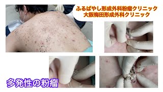 背部の多発性の粉瘤　ブログでも粉瘤について詳しく解説してます。東京皮膚のできものと粉瘤クリニック　ふるばやし形成外科新宿院　大阪梅田形成外科クリニック