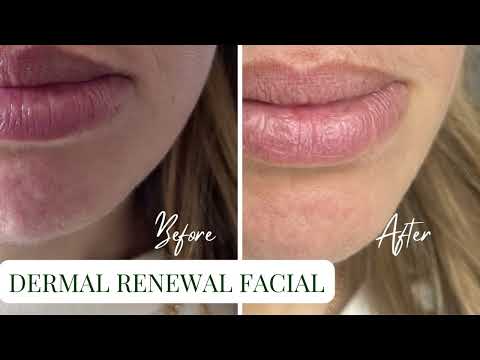 Organic Apoteke Dermal Renewal Facial Before &amp; After