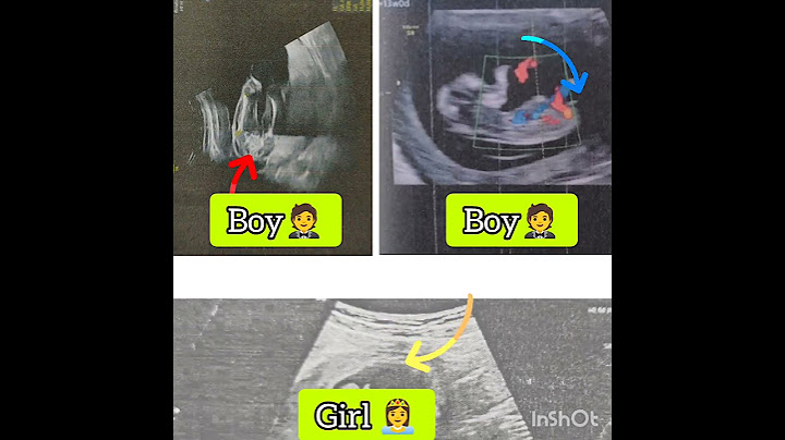 Ultrasound scan report baby boy or girl? Gender reveal #shorts #genderreveal #ultrasound #boyorgirl