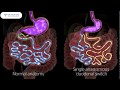 SIPS Surgery in Perth, WA|| Single Anastomosis Duodenal Switch (Loop Duodenal Switch)|| Dr Ravi Rao