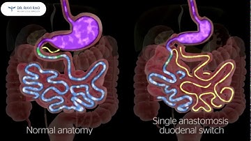 SIPS Surgery in Perth, WA|| Single Anastomosis Duodenal Switch (Loop Duodenal Switch)|| Dr Ravi Rao