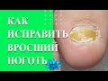 Вросший ноготь на большом пальце ноги. Восстановление ногтей.